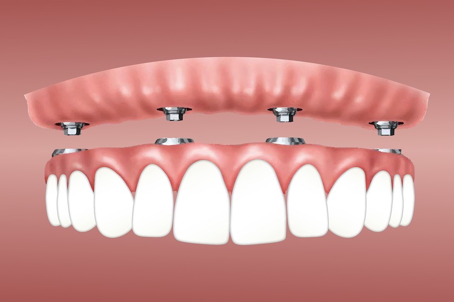 zubni implantati
